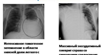 жидкость скапливается в плевральной области