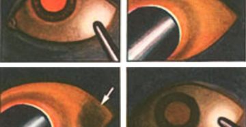 Трансиллюминация и диафаноскопия глазного яблока