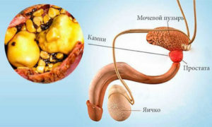 Можно ли делать массаж предстательной железы при кальцинатах