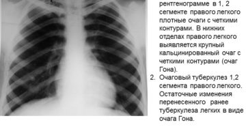 Обнаружен очаг в легких