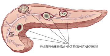 Киста поджелудочной железы