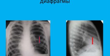 Релаксация диафрагмы справа, кардио-диафрагмальная спайка