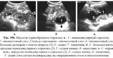 Опухоли червеобразного отростка