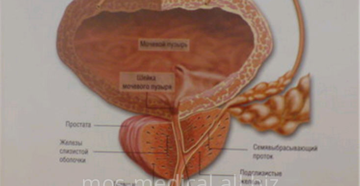 фиброзные включения по ходу простатической ypeтры