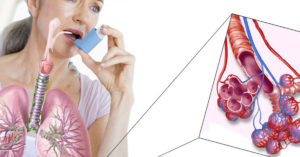 Заболевания, которые похожи на астму (подражатели астмы) (продолжение...)