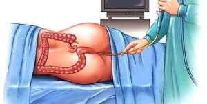 Ректороманоскопия при беременности