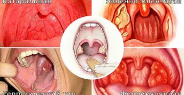 Ангина гнойная при беременности на сроке 30 недель