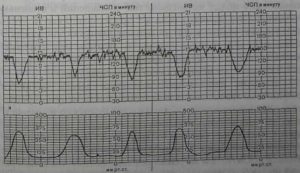 Интранатальная кардиотокография