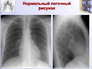 ФЛГ: Обогащён прикорневой лёгочный рисунок