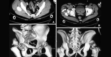 Результаты обследования МСКТ костей таза