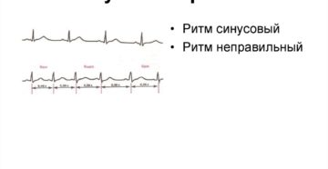 Неправильный ритм сердца (аритмия)