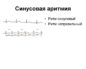 Неправильный ритм сердца (аритмия)