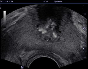 Кальцинаты в простате
