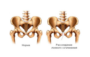 разрыв лонного сочленения при родах