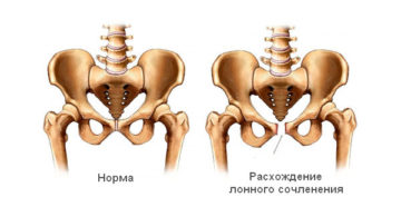 разрыв лонного сочленения при родах