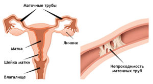 Непроходимость маточных труб