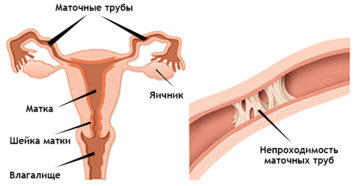 Непроходимость маточных труб