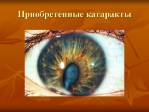 Приобретенные катаракты