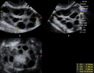 УЗИ МАЛОГО ТАЗА. Неоднородная мультифолликулярная структура яичников