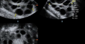 УЗИ МАЛОГО ТАЗА. Неоднородная мультифолликулярная структура яичников