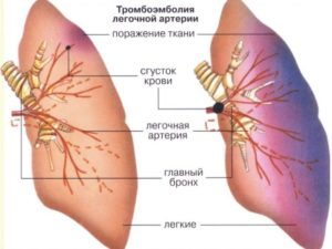 Эмболия легочной артерии