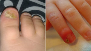 Отваливаются ногти у ребёнка