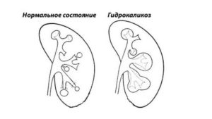 гидрокаликоз при беременности