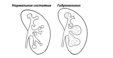 гидрокаликоз при беременности