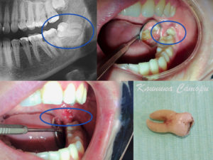Болит зуб мудрости: что делать?