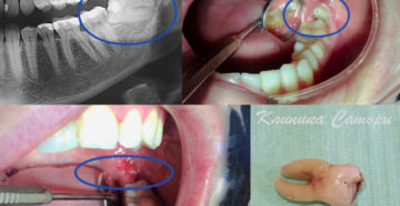 Болит зуб мудрости: что делать?