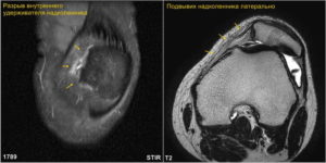 Частичный разрыв медиального удерживателя надколенника 2 степени, синовит