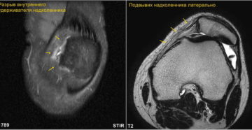 Частичный разрыв медиального удерживателя надколенника 2 степени, синовит