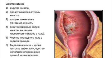 Слабые позывы к дефекации