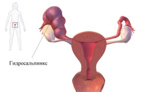гидросальпинкс и беременность