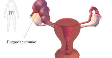 гидросальпинкс и беременность