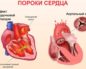 Пороки сердца