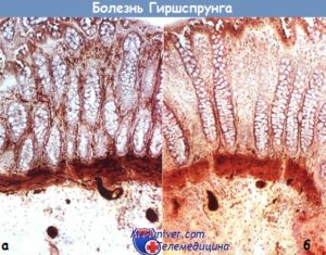 Болезнь Гиршпрунга (аганглионарный мегаколон)