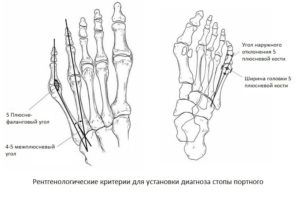 Головки плюсневых костей