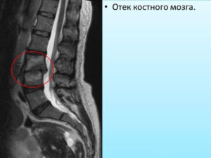 Как лечить трабекулярный отек позвонка