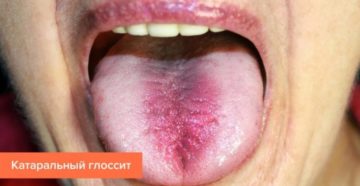 Основные заболевания языка: болезненный или обесцвеченный язык