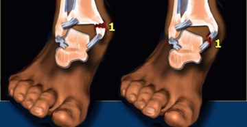 Перелом лодыжки не срастается