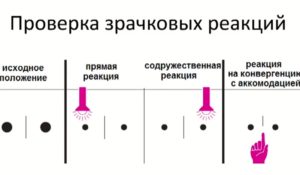 Исследование зрачков и зрачковых реакций