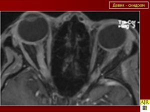 Синдром Девика