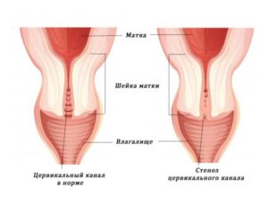 дискомфортное сжения матки