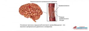 Ишемический инсульт головного мозга