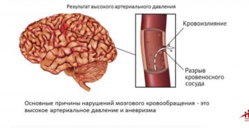 Ишемический инсульт головного мозга