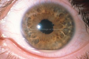 Ювенильный артрит и глаза