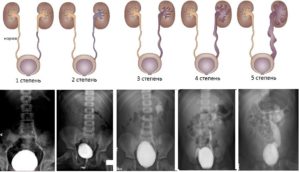 Пузырно мочеточниковый рефлюкс 2 степени у 8 мес ребенка