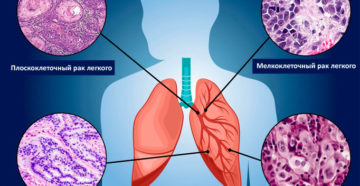Типы рака лёгких