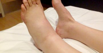 Отёки ног после операции